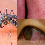 Pag-unawa sa Pagkakaiba ng Dengue, Chikungunya, at Zika: Tatlong Bantang Dapat Bantayan