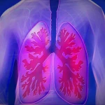 ILD: Rare Lung Disease na Dapat Bigyang-Pansin