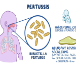 Pag-alam sa Sintomas ng Pertussis at mga Paraan ng Pag-iwas